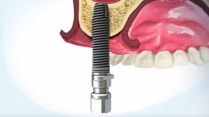 Minimally invasive sinus lift with iRaise