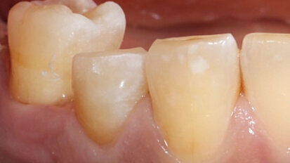 Fig. 4. Únicamente se acortaron por oclusal las paredes remanentes de la cavidad.
