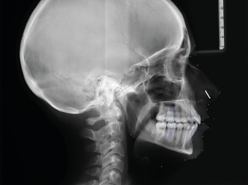 Fig. 8b : radiographie céphalométrique finale. 