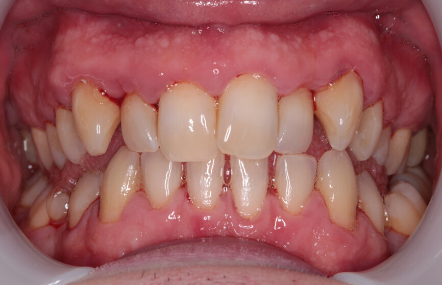 Fig. 7: Post-scaling anterior view