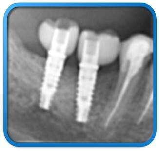 Figg. 15, 16_Controllo radiografico post-implantare e follow-up ad 1 anno.