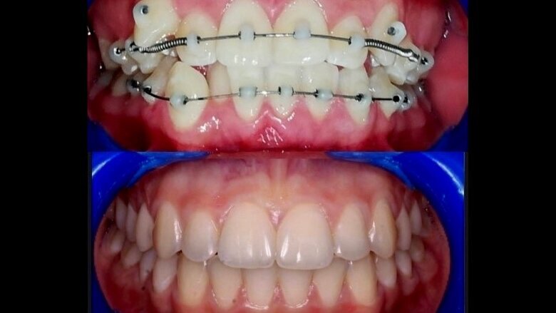 Ortodoncia fija sin brackets con la técnica SLIDE OD