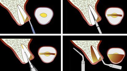      Piezocirugía  8    La llegada de la exodoncia atraumática