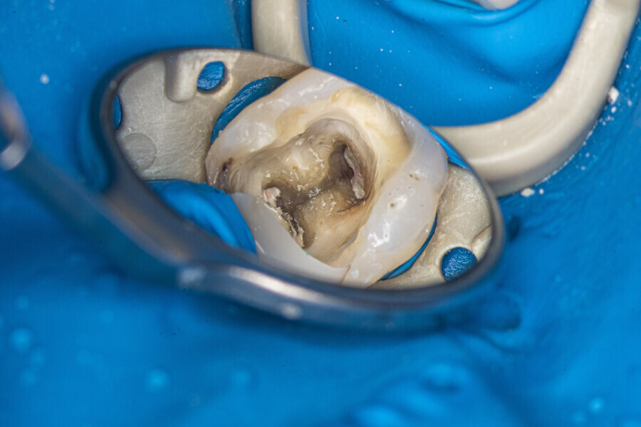 Fig. 16: Tooth after removal of the restoration.