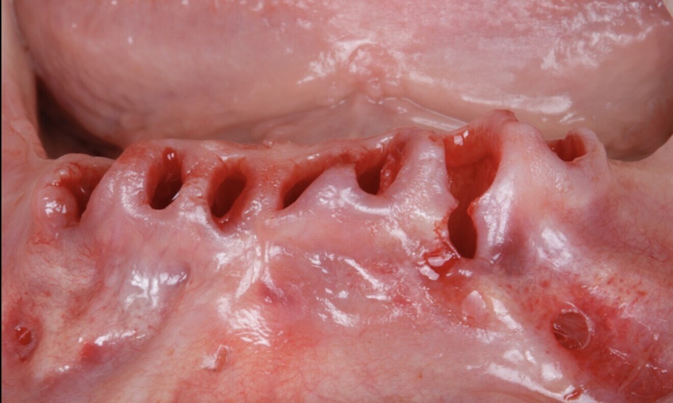 Figs. 32 & 33: The hopeless teeth were atraumatically extracted.