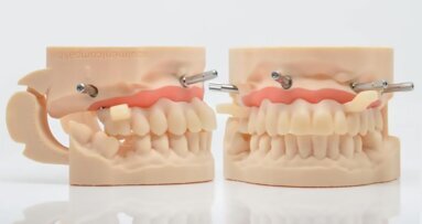 Stampa 3D in odontoiatria: tecniche avanzate per modelli, corone e abutment su Ti-Base