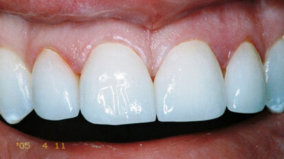 Healthy and harmonised function via computer-guided occlusal force management