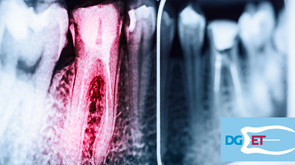 Noch freie Plätze beim Curriculum Endodontie der DGET