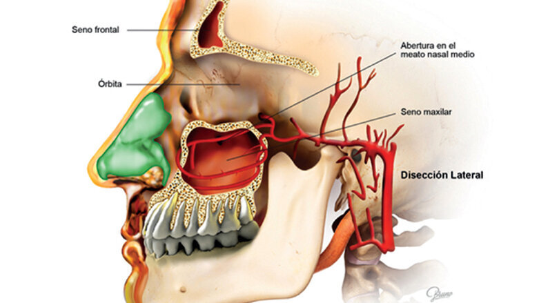 La importancia de la anatomía sinusal