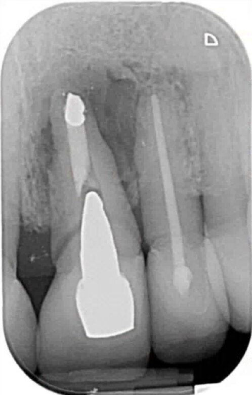 Fig. 3: 2-D X-ray.