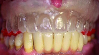 Empreinte et enregistrement pour prothèses complètes amovibles supra-implantaires