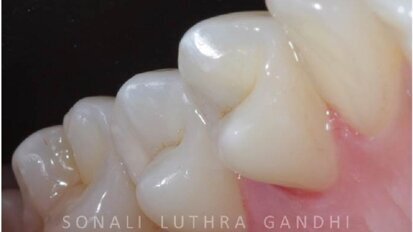 Management of proximal posterior lesions: A case report