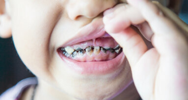 Duration of breastfeeding may impact dental caries