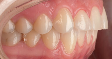Infra-zygomatic crest screws for absolute anchorage in maxillary distalisation: A focus on aligner treatment optimisation