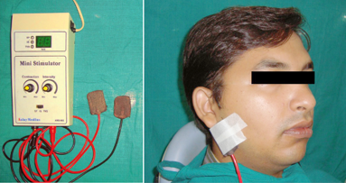 Electric therapy may relieve dry mouth