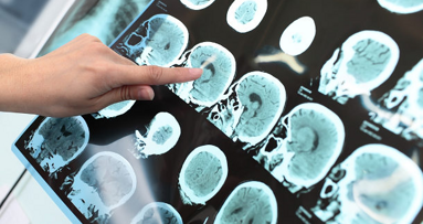 Slechte mondgezondheid leidt mogelijk tot alzheimer