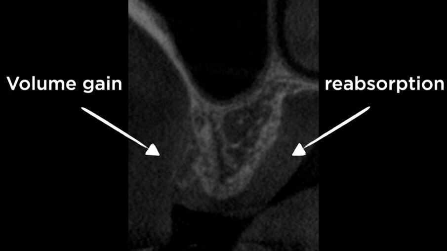 Figg. 7a, 7b - CBCT dopo Inibizione Periostale Modificata.