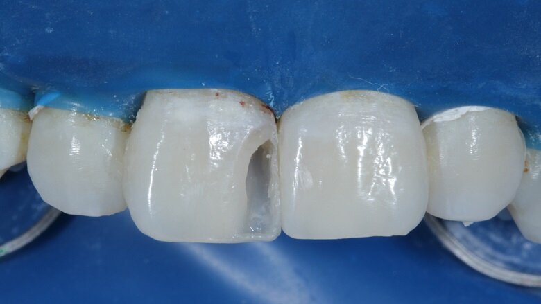 Fig 15: Proximal box 