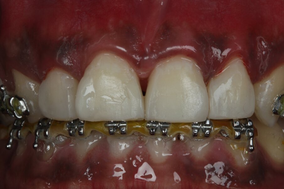 Fig 17: Gross finishing done