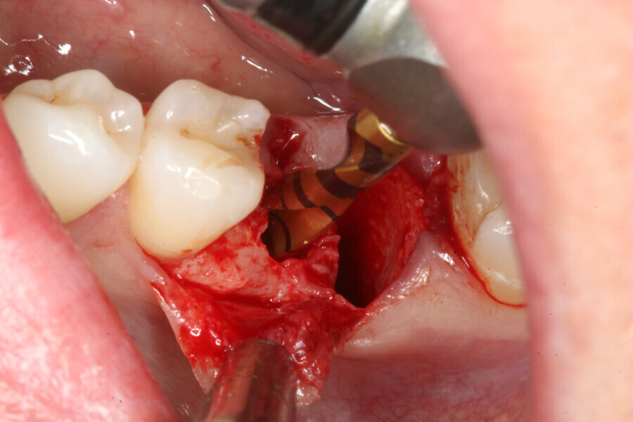 Fig. 2: Implant site preparation.