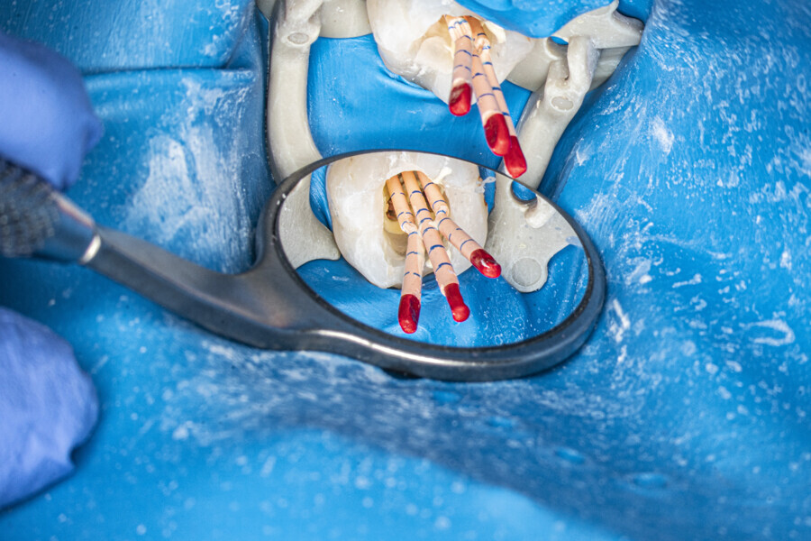 Fig. 32: Gutta-percha cones fitted in all three distal canals at the same time.