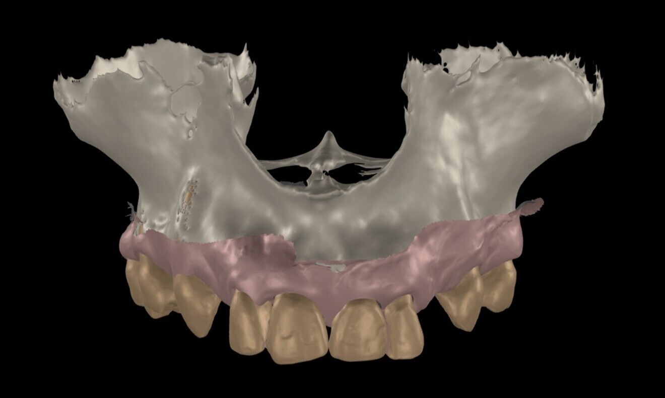 Fig. 8 & 9: Digital impression was captured using the TRIOS intra-oral scanner.