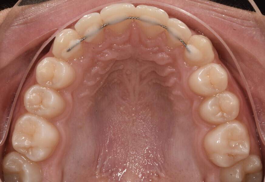 Fig. 8: Facial and intra-oral photographs after treatment with fixed orthodontic appliances.