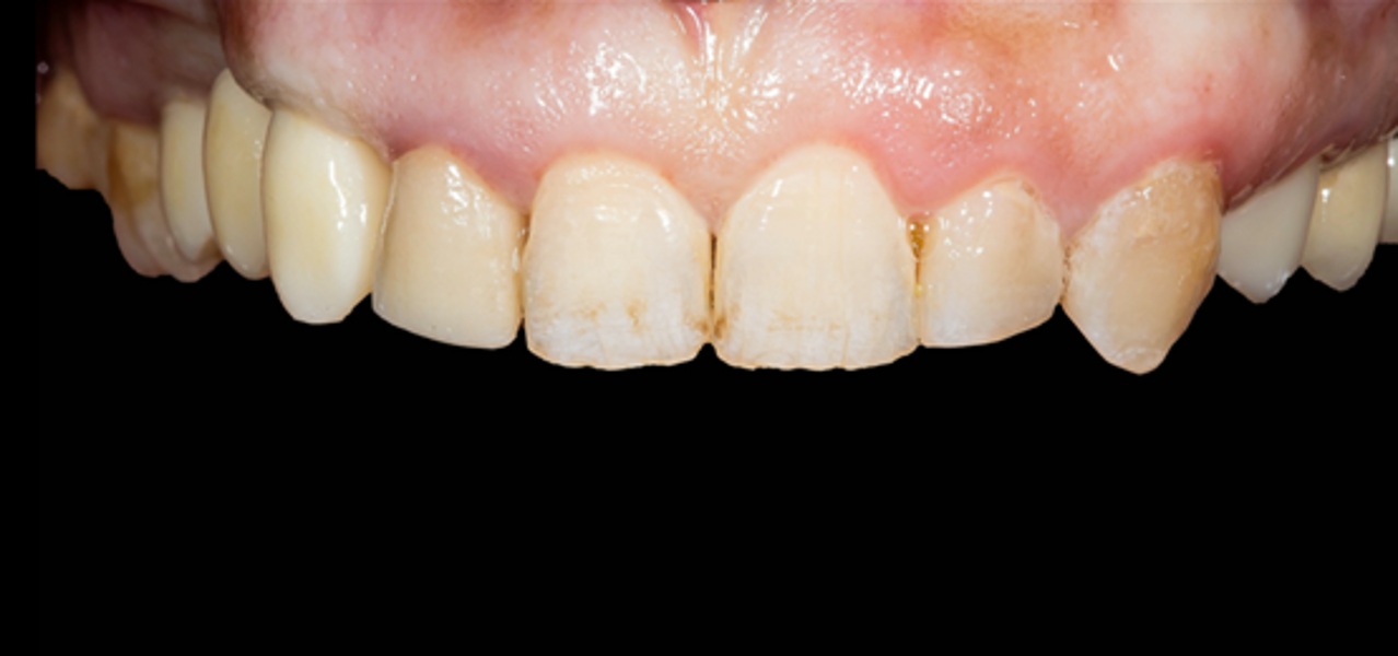 Fig. 15: Final restoration in the patient’s mouth, frontal view.