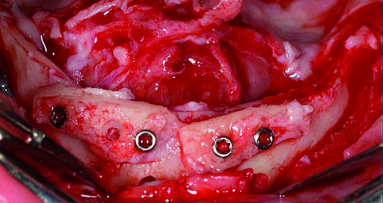 Augmentation and implant treatment: Two-stage surgery in the severely resorbed edentulous mandible