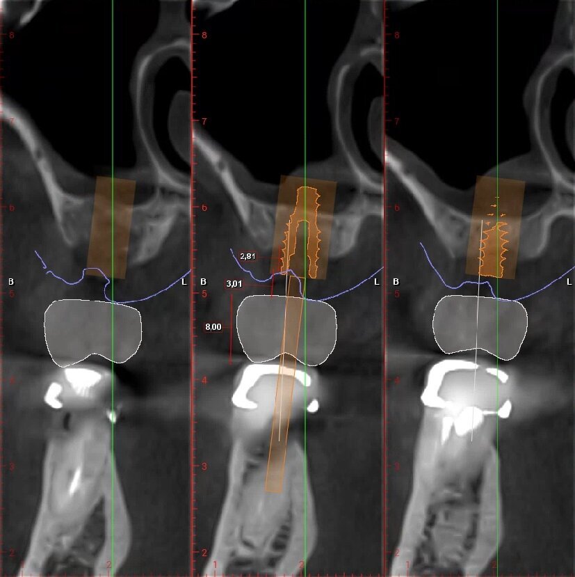 Fig. 7_Pianificazione implantare protesicamente guidata dell’elemento 2.6.