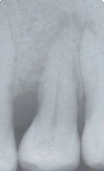 Fig. 12b - Rx a 6 mesi.