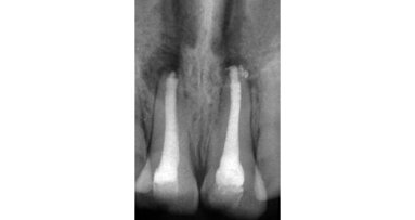 Apexification with mineral trioxide aggregate (MTA): A case report