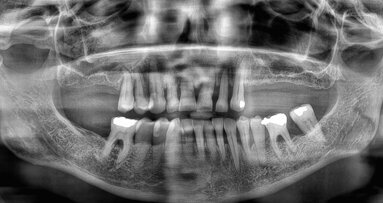 Immediate loading of the posterior maxilla with two abutment-level bridges produced in a digital workflow