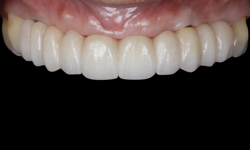 Figs. 78–82: The definitive restorations were placed, and occlusal adjustments were performed.