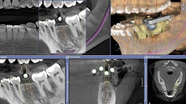 Guided implant surgical placement with CAD/CAM CEREC crown