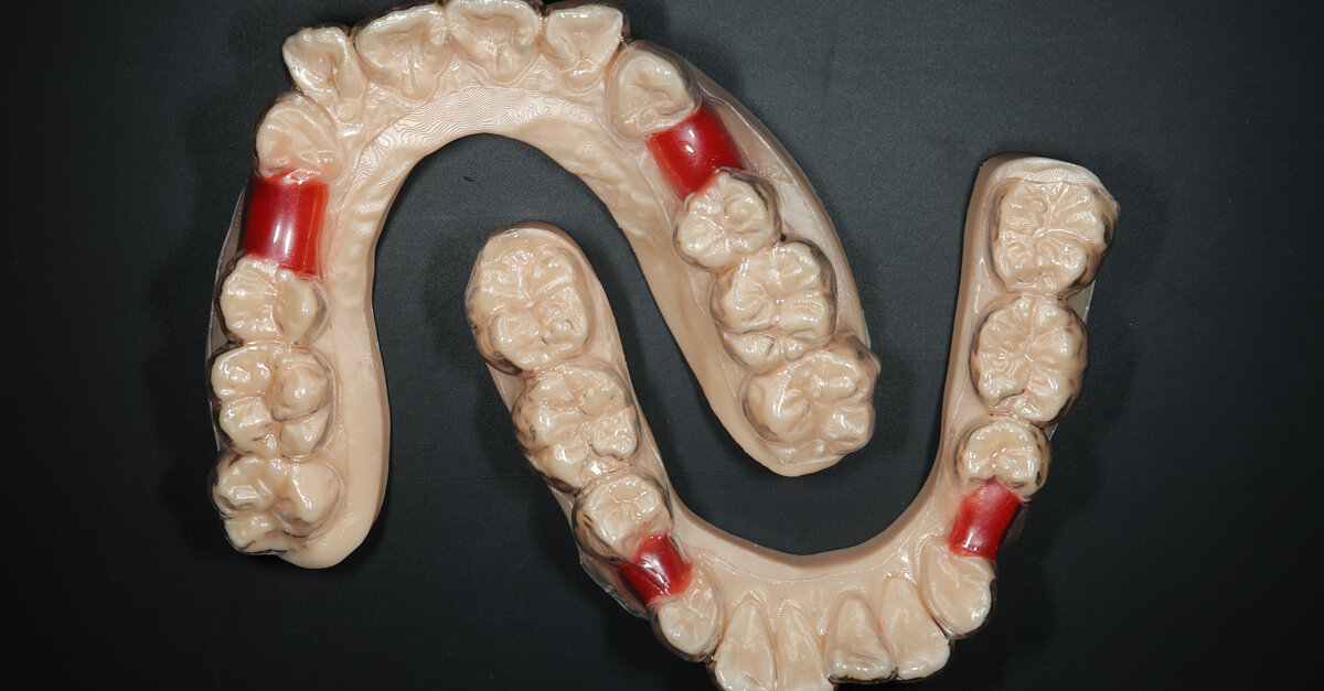 In-house 3D-printing workflows for implant restorations