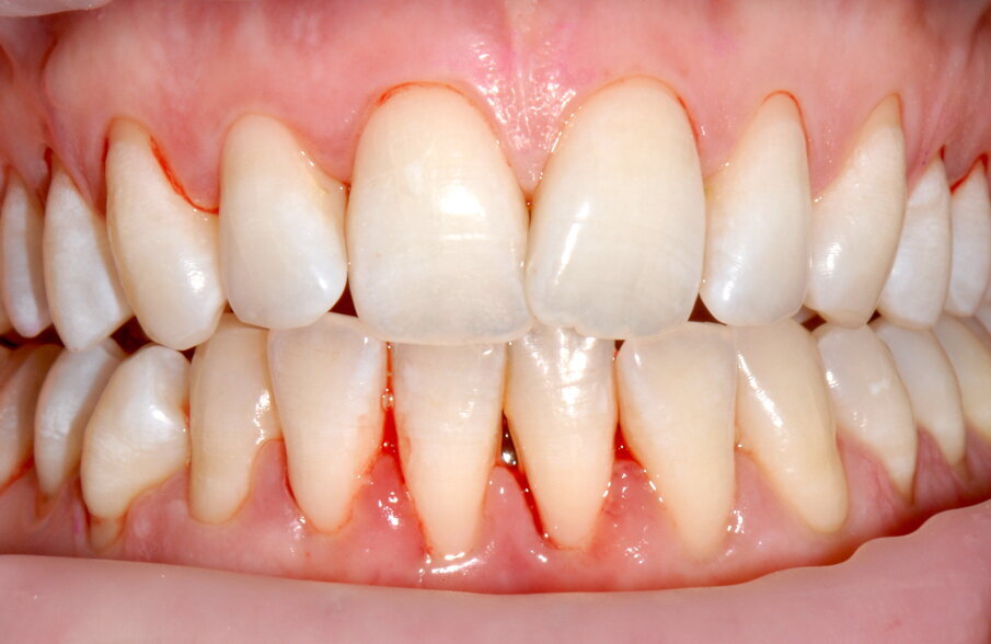 Figg. 3a-3c - Termine della terapia. nelle visioni vestibolare (3a), palatale (3b) e linguale (3c).