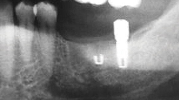 Intro to CBCT as it pertains to prevention of failures in oral implantology