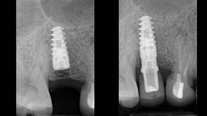 Preparace štoly pro implantát digitálním Er:YAG laserovým násadcem