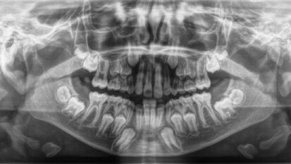 Terapia chirurgico-ortodontica di un canino mandibolare incluso