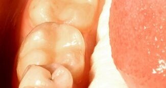 BPA може да се отделя чрез слюнката и урината след поставяне на композитна обтурация