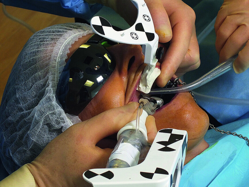 Fig. 6: Preparation of upper right second premolar implant site.