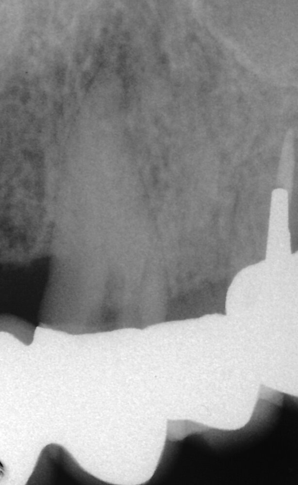Fig. 3a: (a) Radiolucency in the cervical part of the canine. (b) Bleeding from the perforation. (c) MTA application with the MAP System and PD MTA White. (d) Original canal and repair of root perforation. (e) Post-op radiograph showing the root canal filling.