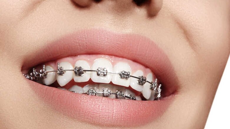 Un adhesivo que evita las caries en los brackets