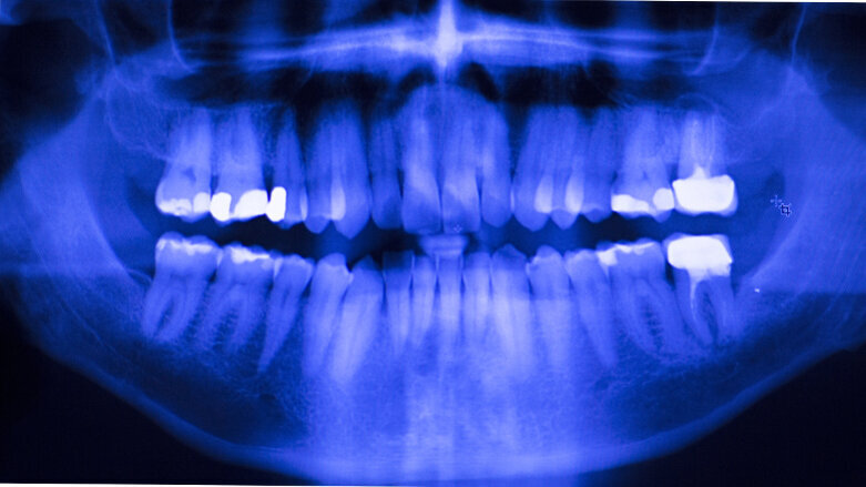 Moving away from amalgam: New online tool helps dentists choose suitable restorative materials