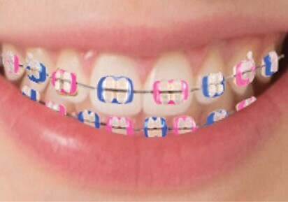 Clarity ADVANCED Ceramic Brackets