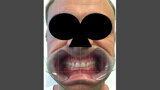 Fig. 4. Protocolo DSD: imagen del paciente sonriendo con un retractor de labios y mejillas.