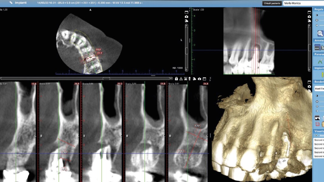 Fig. 11_CBCT T0.