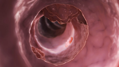 Une bactérie orale peut contribuer au cancer colorectal