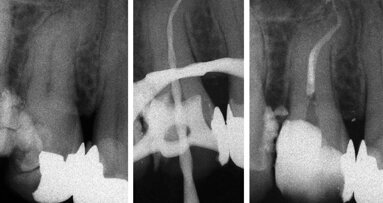 Otturazione canalare mediate la tecnica M-seal: una tecnica efficace anche nelle anatomie complesse
